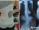 南昌矫形器之脊柱侧弯也要积干预